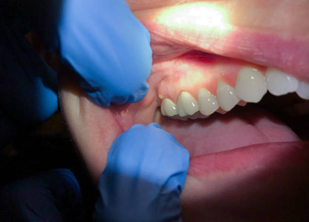 Best Emergency Wisdom Teeth Removal in Warren, PA